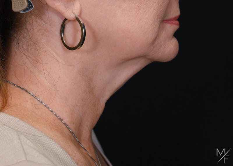 Facelift Before & After Gallery - Patient 370603 - Image 1