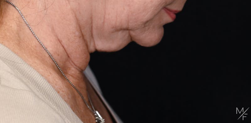 Facelift Before & After Gallery - Patient 370603 - Image 3