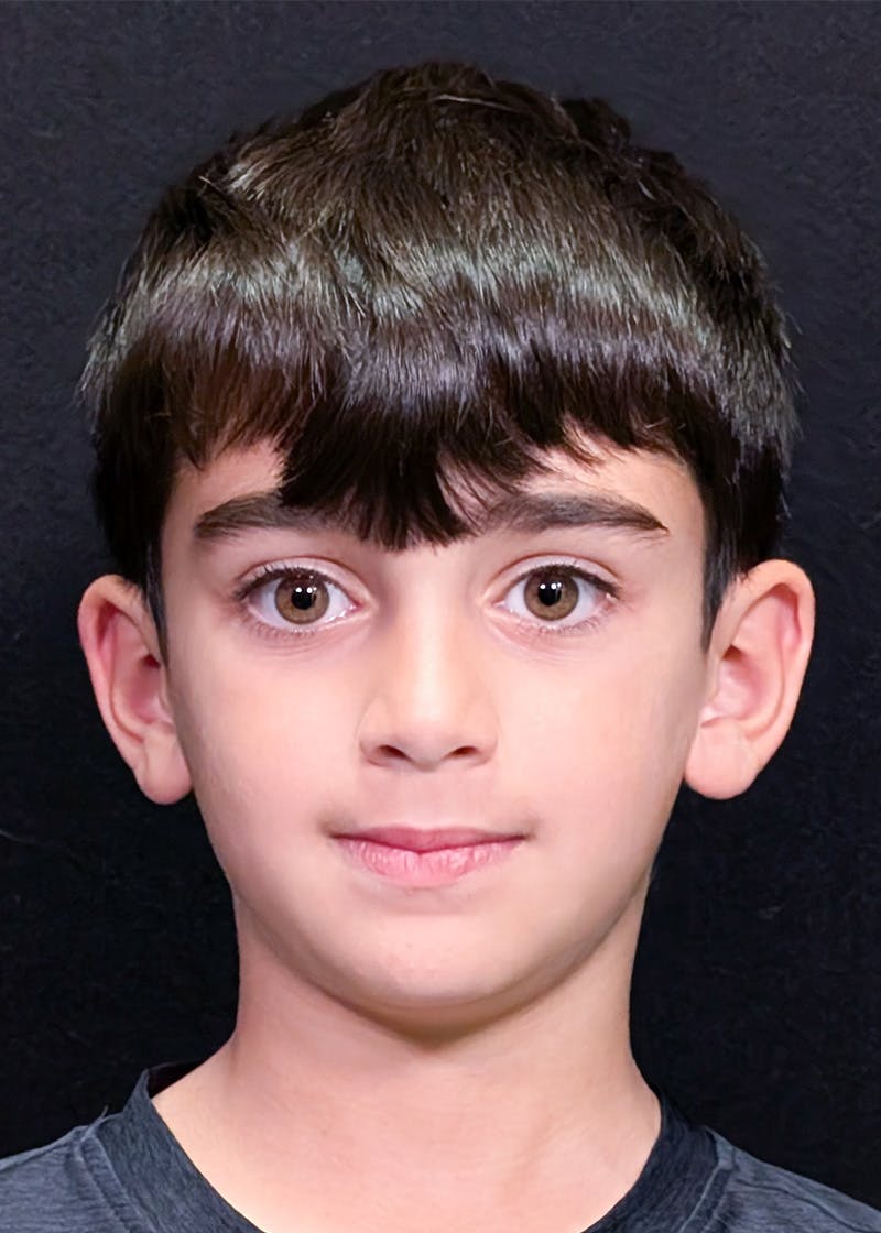 Otoplasty Before & After Gallery - Patient 415780 - Image 1