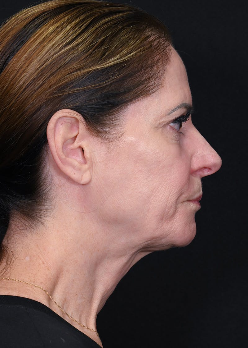 Facelift Before & After Gallery - Patient 223290 - Image 5