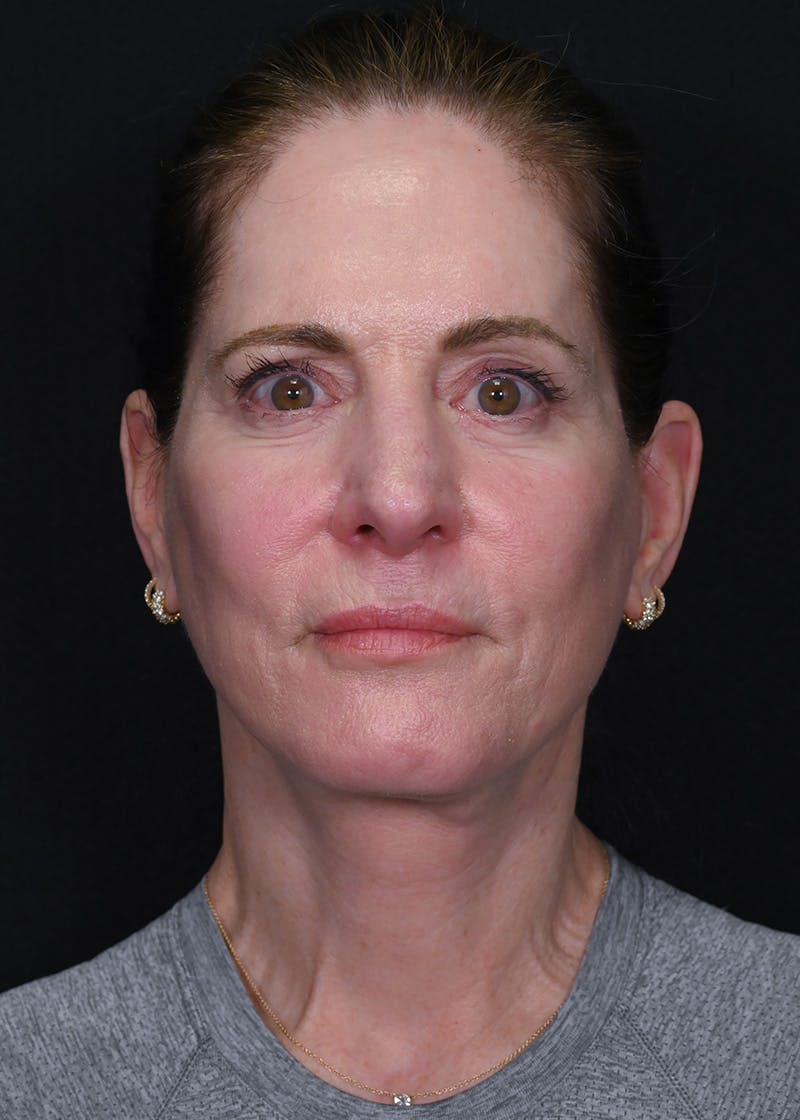 Facelift Before & After Gallery - Patient 223290 - Image 2