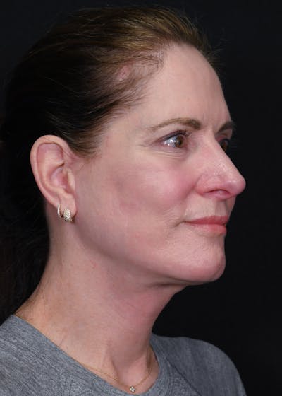Facelift Before & After Gallery - Patient 223290 - Image 2