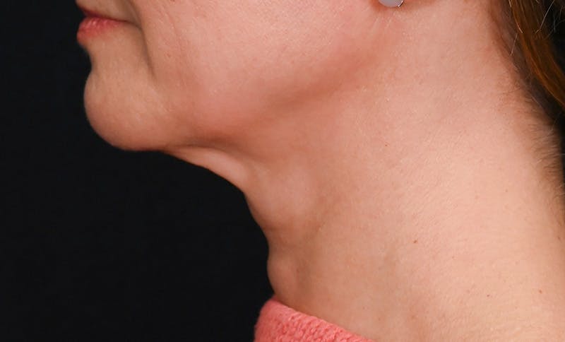 Facelift Before & After Gallery - Patient 178168 - Image 5