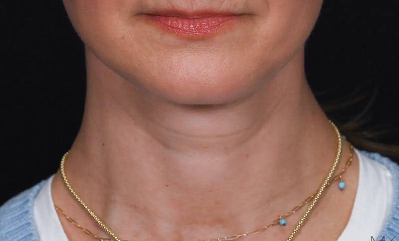 Facelift Before & After Gallery - Patient 178168 - Image 2