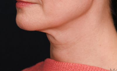 Facelift Before & After Gallery - Patient 178168 - Image 1