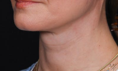 Facelift Before & After Gallery - Patient 178168 - Image 2