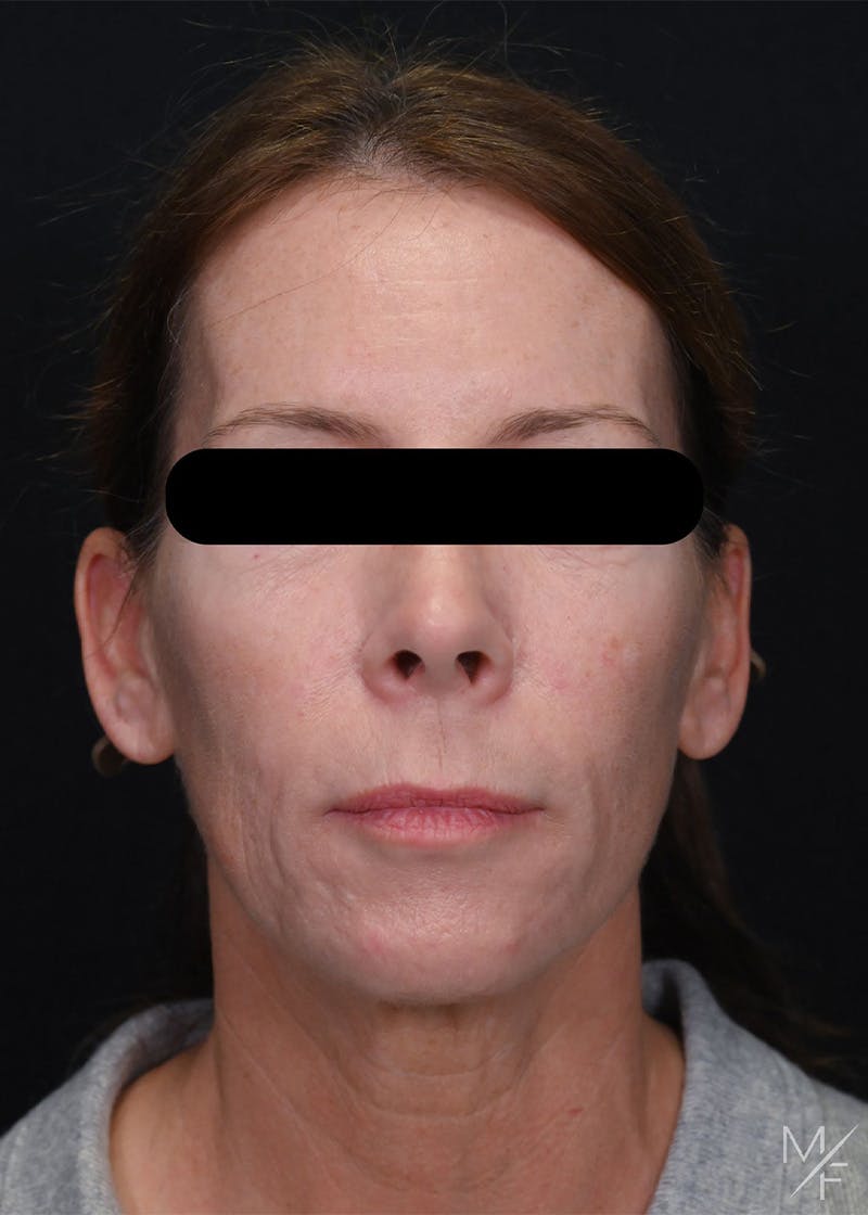 Facelift Before & After Gallery - Patient 423244 - Image 1