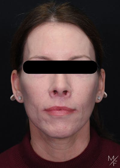 Facelift Before & After Gallery - Patient 423244 - Image 2
