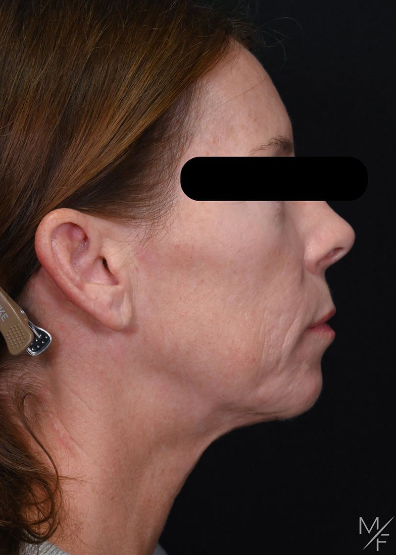 Facelift Before & After Gallery - Patient 423244 - Image 5