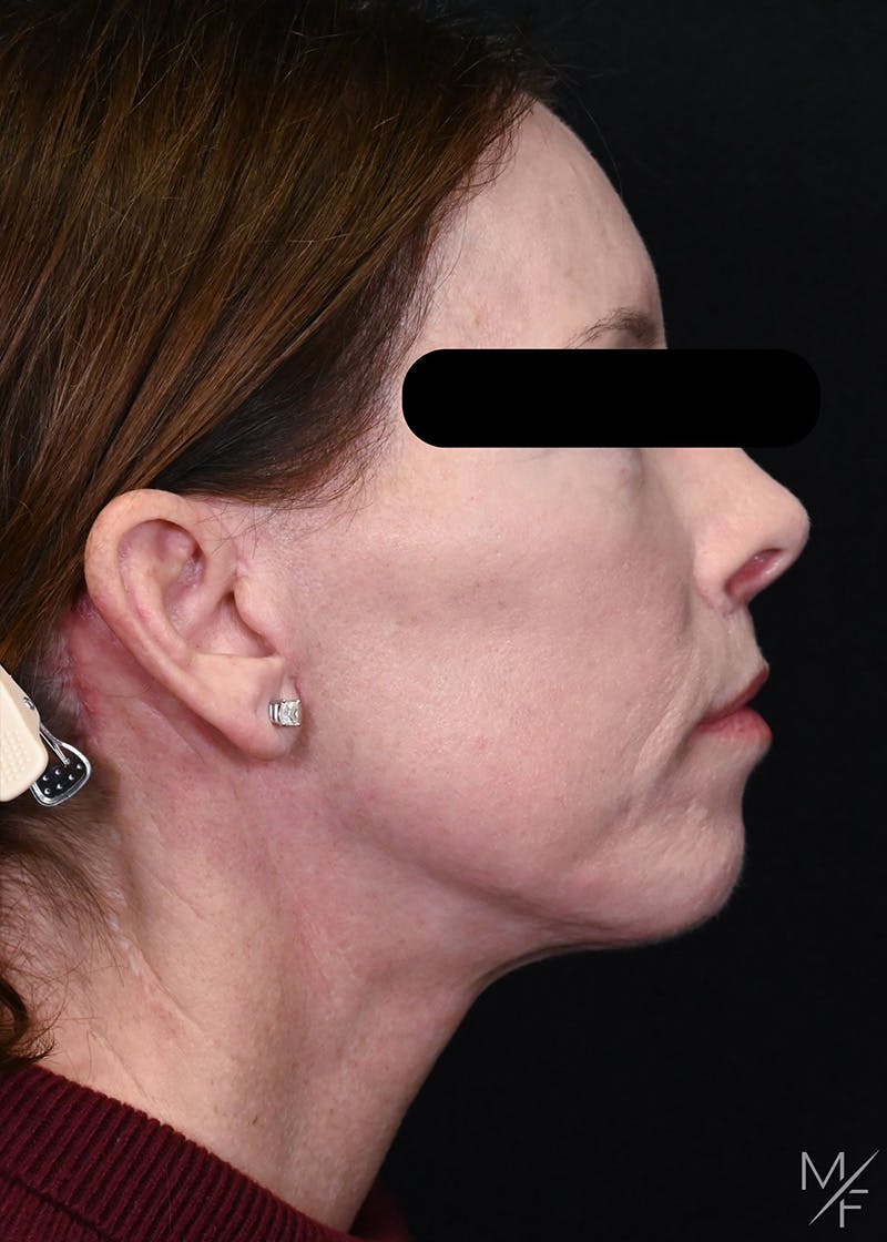 Facelift Before & After Gallery - Patient 423244 - Image 6