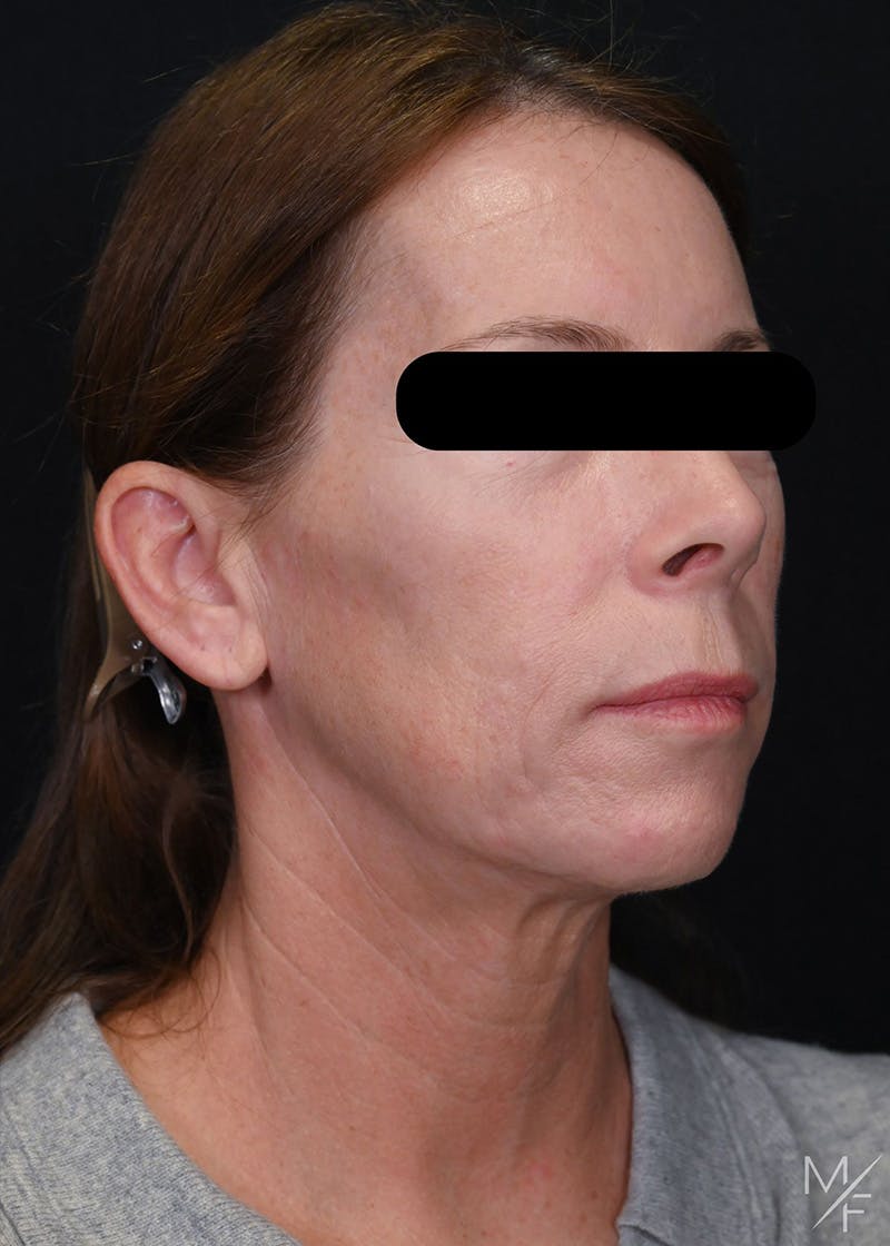 Facelift Before & After Gallery - Patient 423244 - Image 3