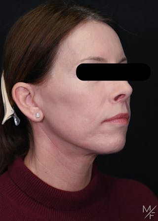 Facelift Before & After Gallery - Patient 423244 - Image 4