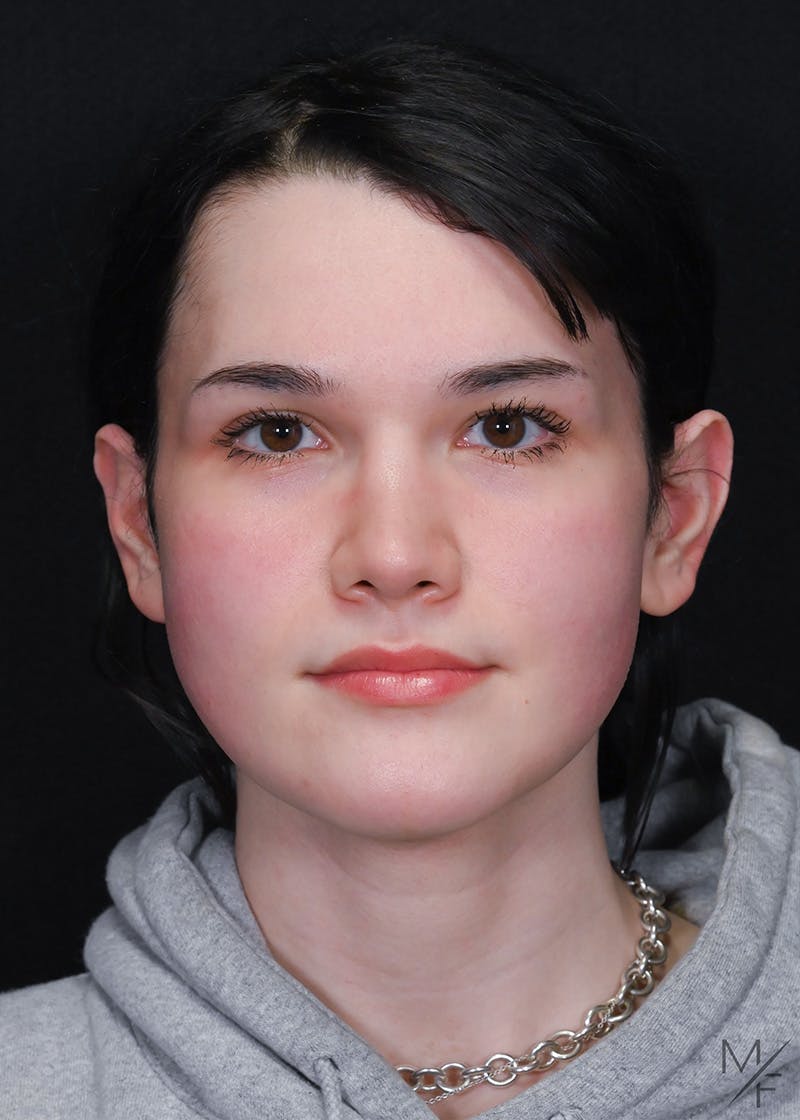 Rhinoplasty Before & After Gallery - Patient 794104 - Image 4