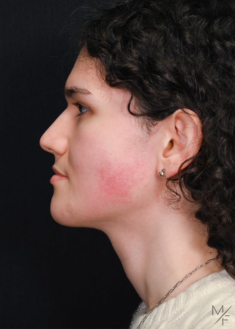 Rhinoplasty Before & After Gallery - Patient 794104 - Image 1