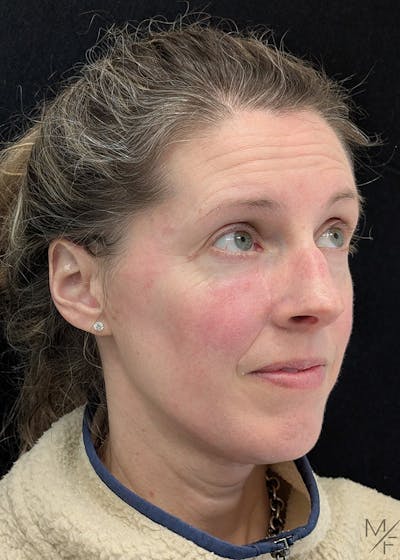 Skin Cancer Reconstruction Before & After Gallery - Patient 300527 - Image 2