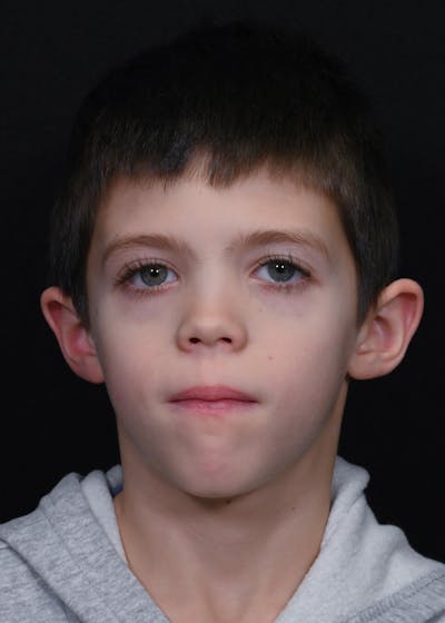 Otoplasty Before & After Gallery - Patient 354576 - Image 1