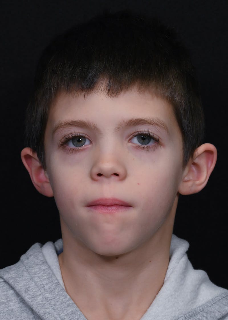 Otoplasty Before & After Gallery - Patient 354576 - Image 1