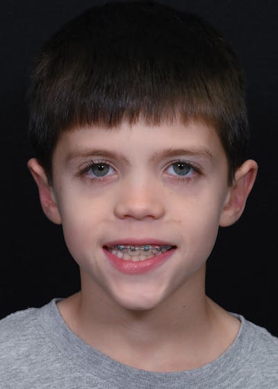 Otoplasty Before & After Gallery - Patient 354576 - Image 2