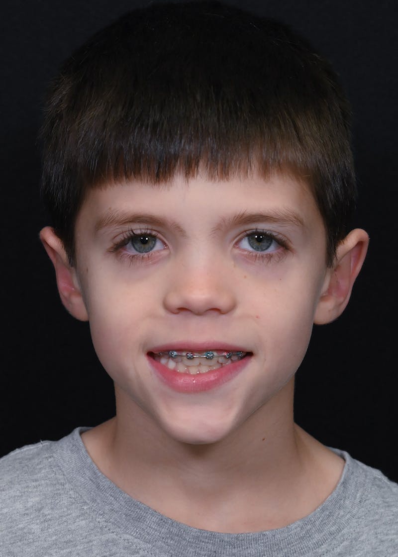 Otoplasty Before & After Gallery - Patient 354576 - Image 2