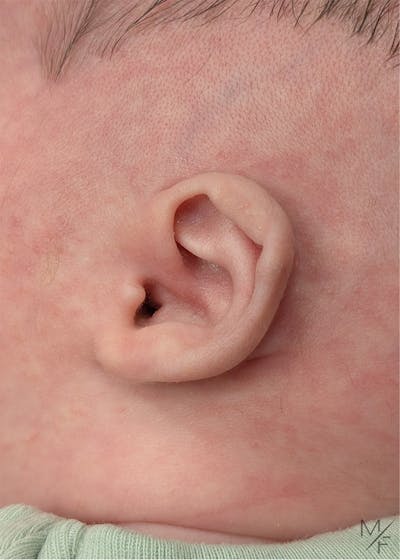Ear Molding Before & After Gallery - Patient 416691 - Image 1