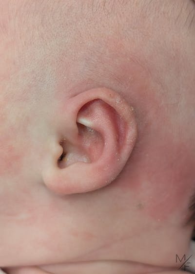 Ear Molding Before & After Gallery - Patient 416691 - Image 2