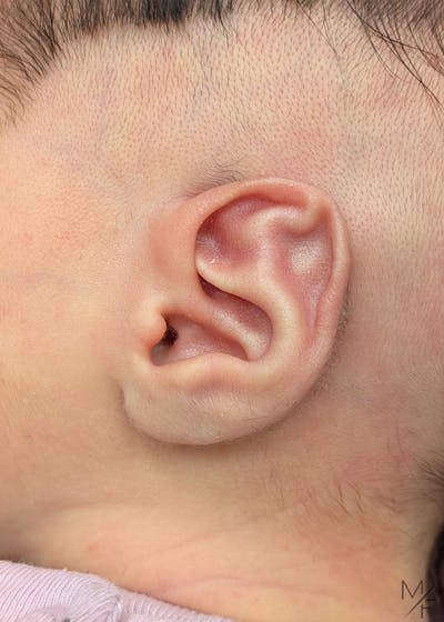 Ear Molding Before & After Gallery - Patient 419728 - Image 1