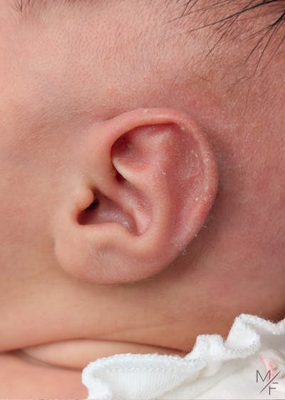 Ear Molding Before & After Gallery - Patient 419728 - Image 2