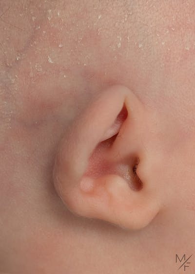 Ear Molding Before & After Gallery - Patient 322880 - Image 1