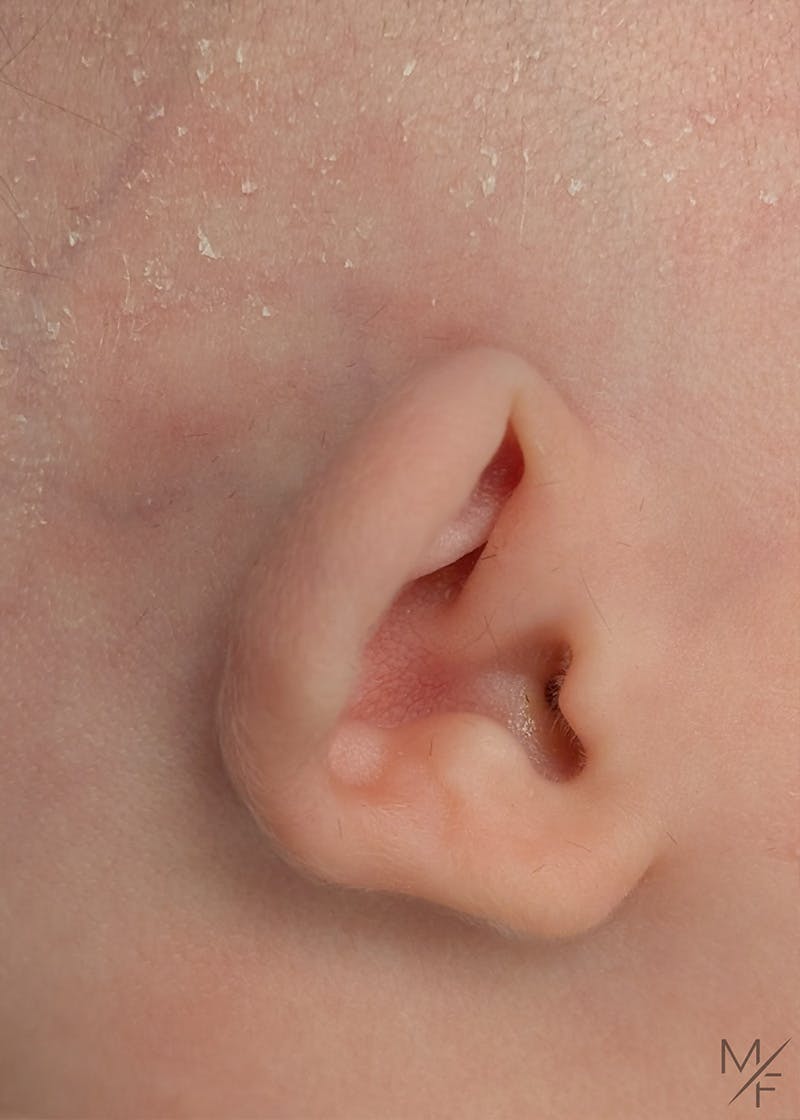 Ear Molding Before & After Gallery - Patient 322880 - Image 1