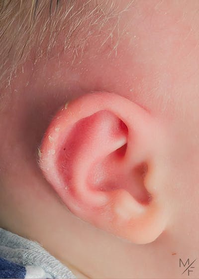 Ear Molding Before & After Gallery - Patient 322880 - Image 2