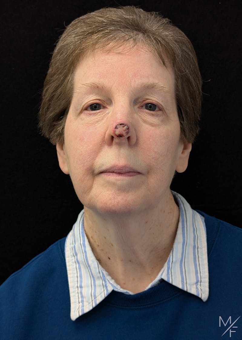 Skin Cancer Reconstruction Before & After Gallery - Patient 426780 - Image 1