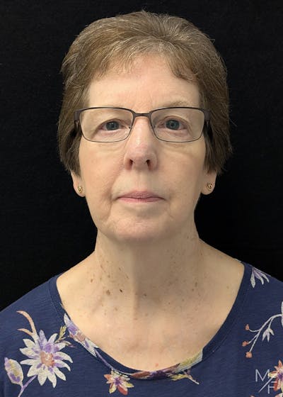 Skin Cancer Reconstruction Before & After Gallery - Patient 426780 - Image 2
