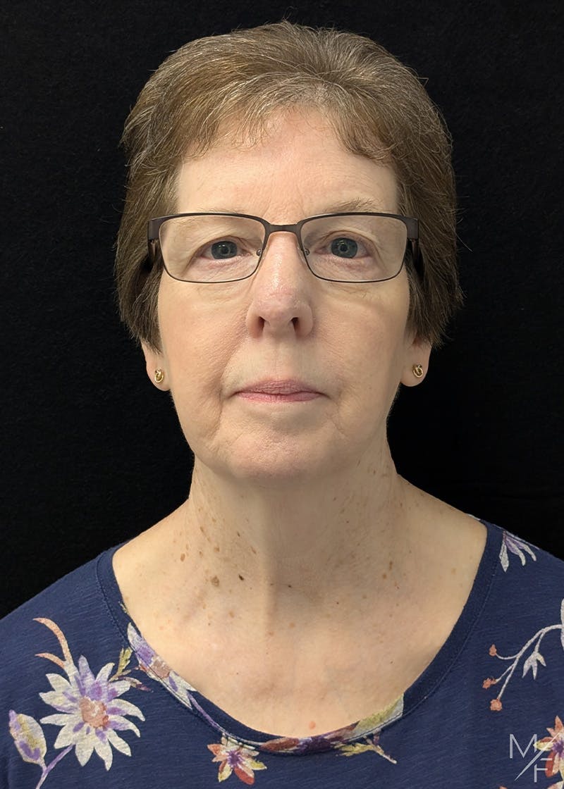 Skin Cancer Reconstruction Before & After Gallery - Patient 426780 - Image 2