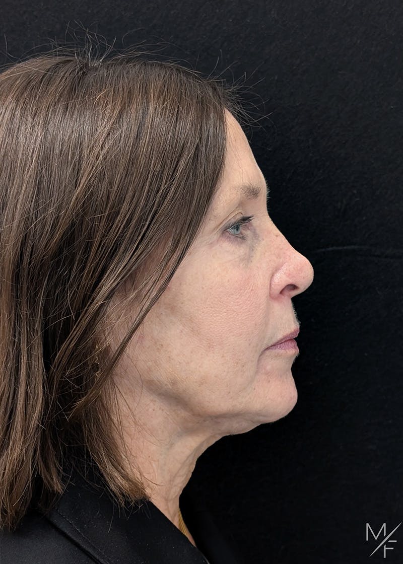 Skin Cancer Reconstruction Before & After Gallery - Patient 115654 - Image 2