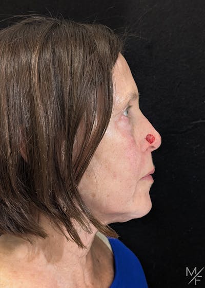 Skin Cancer Reconstruction Before & After Gallery - Patient 115654 - Image 1