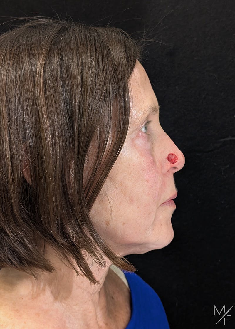 Skin Cancer Reconstruction Before & After Gallery - Patient 115654 - Image 1