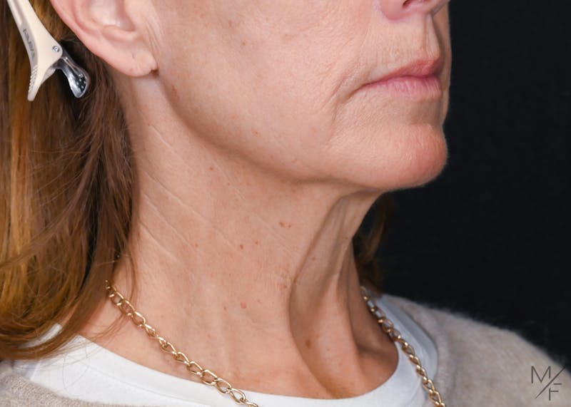 Facelift Before & After Gallery - Patient 839738 - Image 1