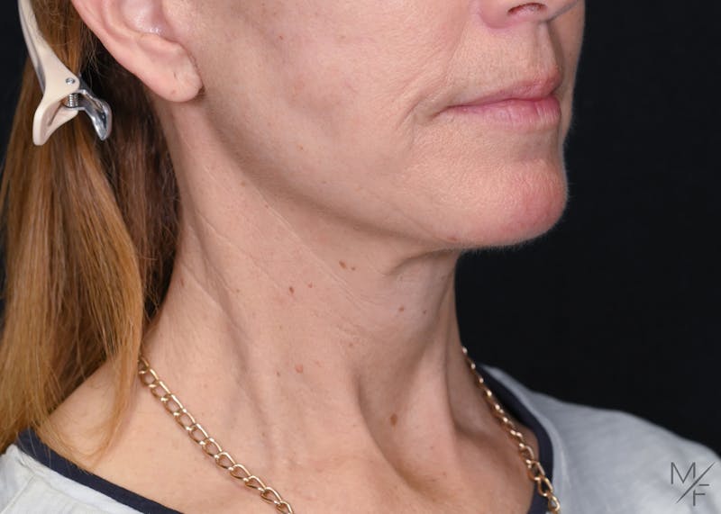 Facelift Before & After Gallery - Patient 839738 - Image 2