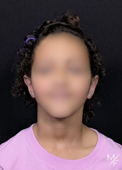 Otoplasty Before & After Gallery - Patient 298708 - Image 2
