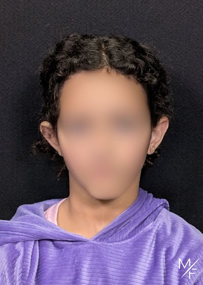 Otoplasty Before & After Gallery - Patient 298708 - Image 1