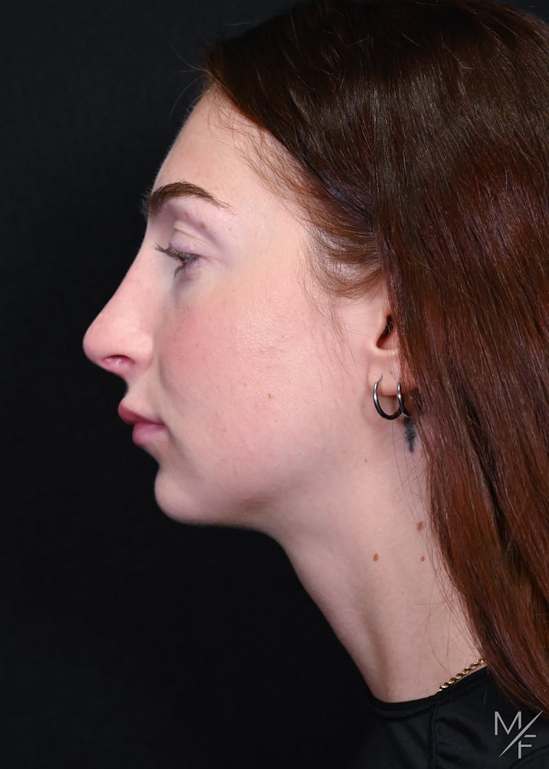 Rhinoplasty Before & After Gallery - Patient 529311 - Image 2