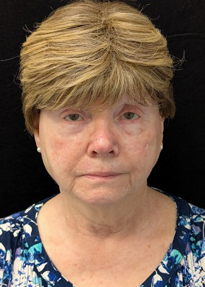 Skin Cancer Reconstruction Before & After Gallery - Patient 599469 - Image 2
