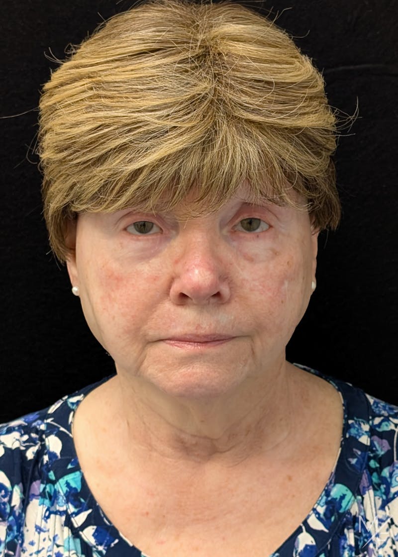 Skin Cancer Reconstruction Before & After Gallery - Patient 599469 - Image 2