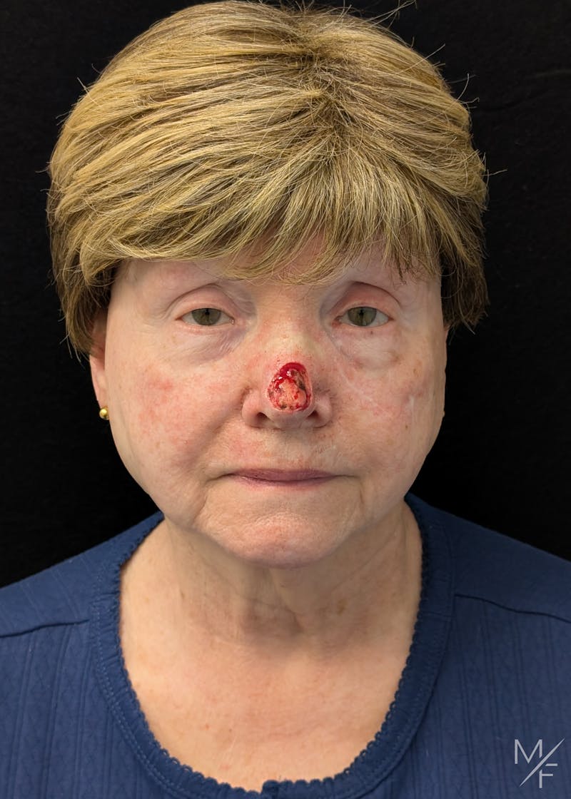 Skin Cancer Reconstruction Before & After Gallery - Patient 599469 - Image 1