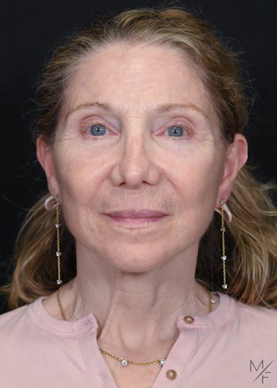 Facelift Before & After Gallery - Patient 762195 - Image 2