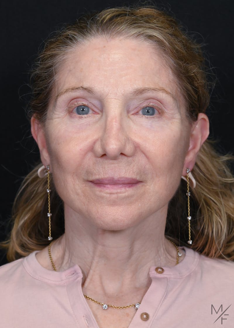 Facelift Before & After Gallery - Patient 762195 - Image 2