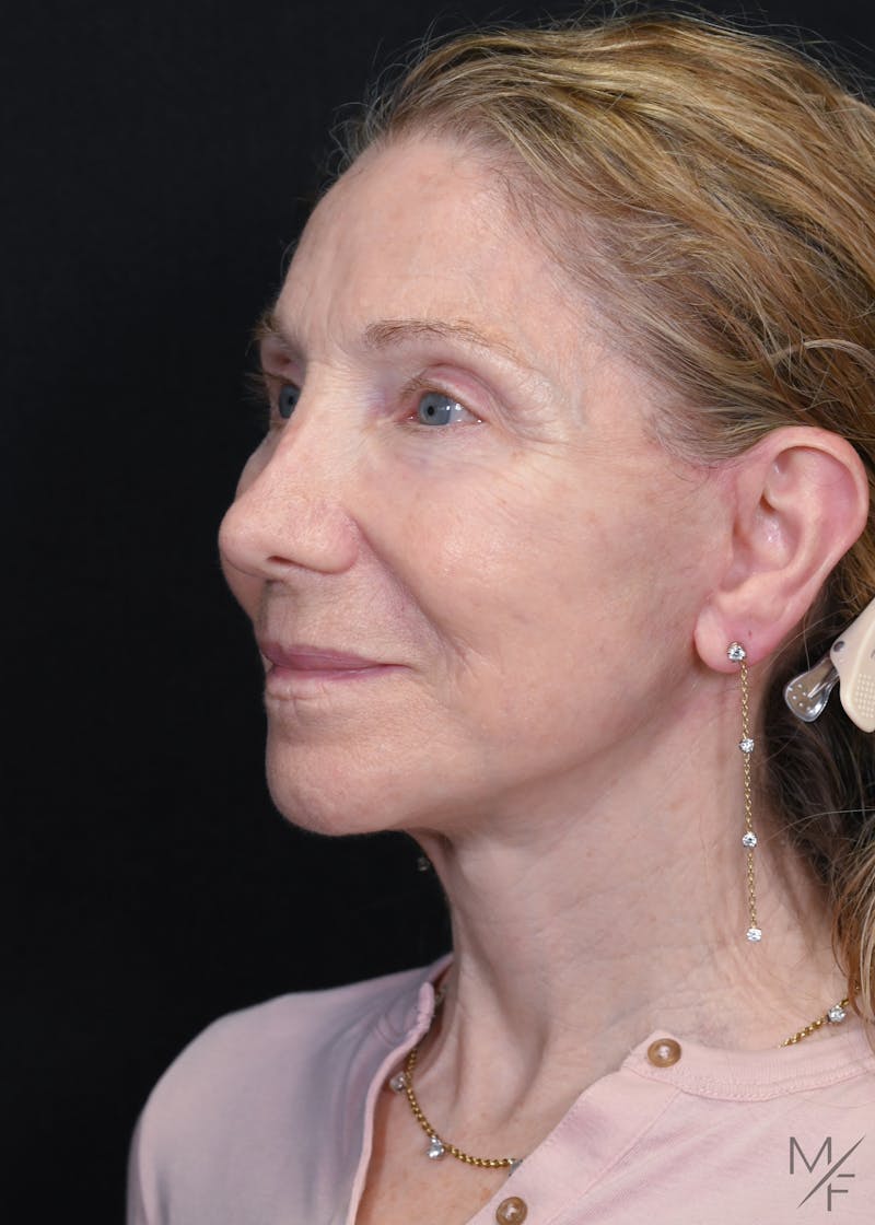 Facelift Before & After Gallery - Patient 762195 - Image 4