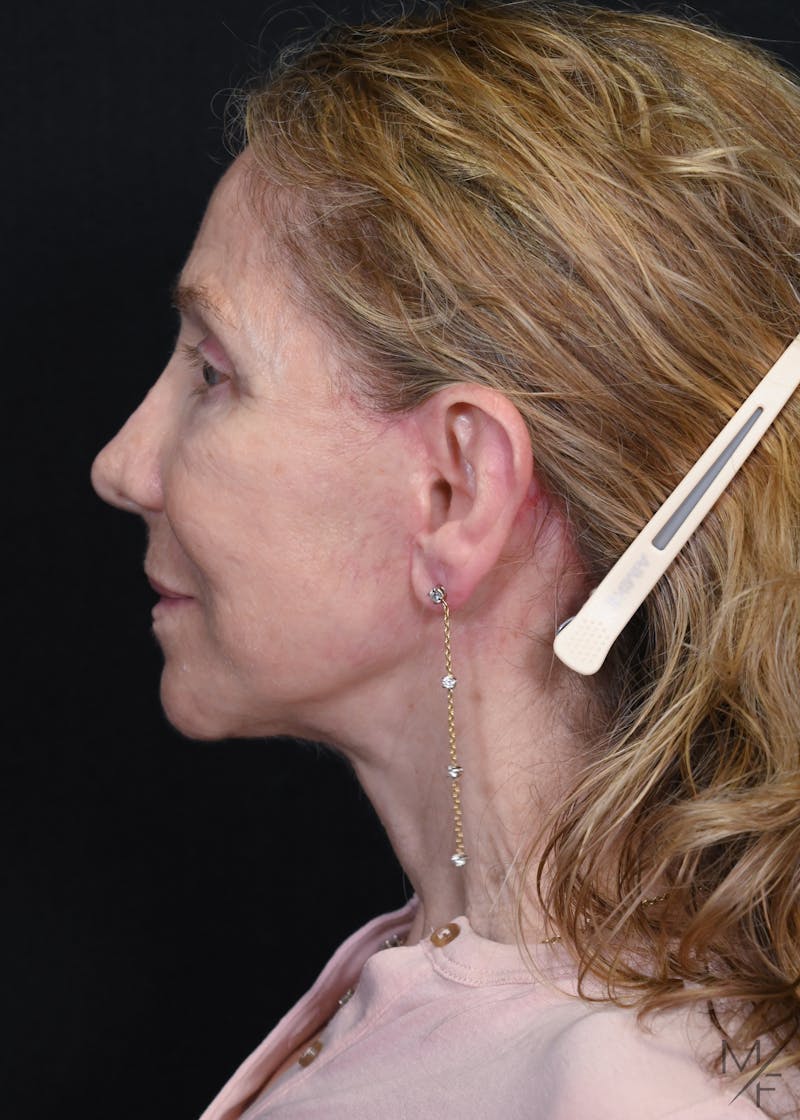 Facelift Before & After Gallery - Patient 762195 - Image 6