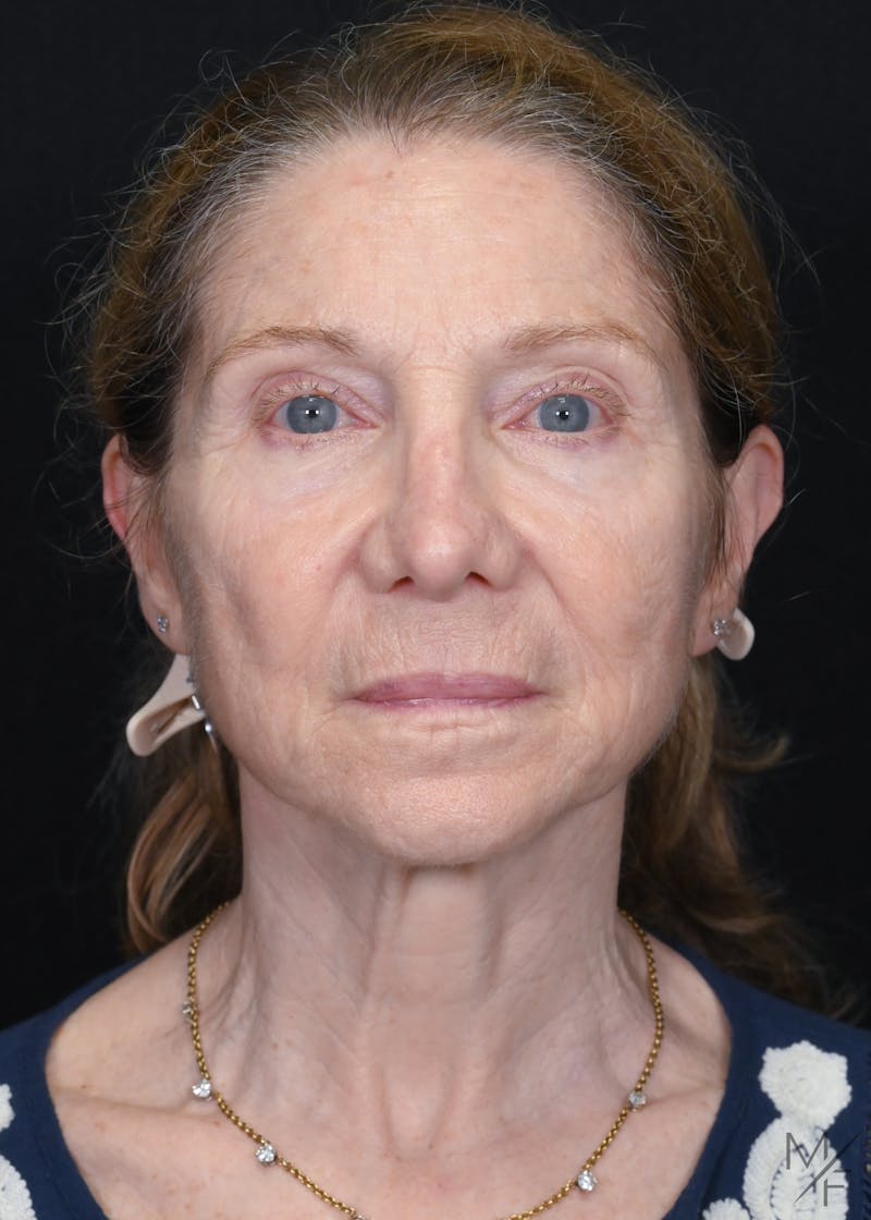 Facelift Before & After Gallery - Patient 762195 - Image 1