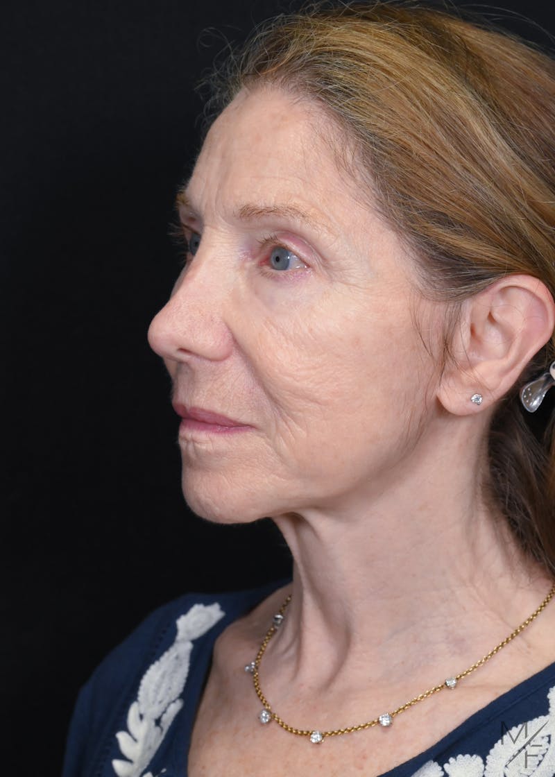Facelift Before & After Gallery - Patient 762195 - Image 3